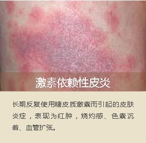 面部脂溢性皮炎辨别图片,面部脂溢性皮炎怎么治