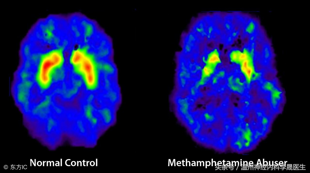 脑出血李医生,脑出血病例分析及答案