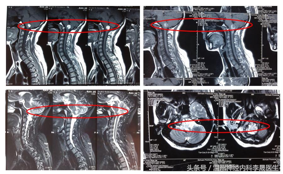 脑出血李医生,脑出血病例分析及答案