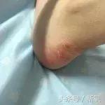 脚后跟防磨神器哪种好用,有的人表面光鲜亮丽脚痛