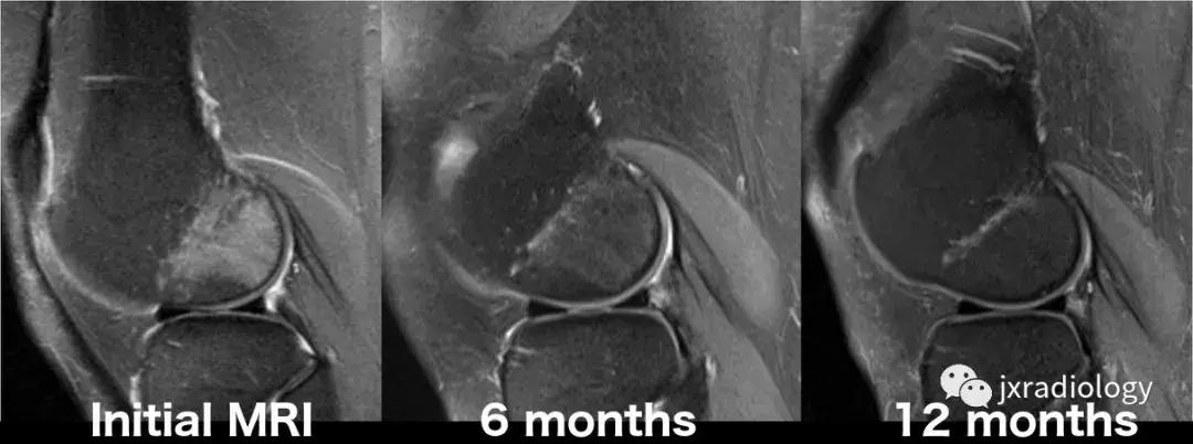 膝关节骨髓水肿疼痛特点,膝关节骨髓水肿的临床表现