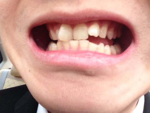 牙齿还没掉落就长出牙歪了怎么办,才补完牙很毛躁