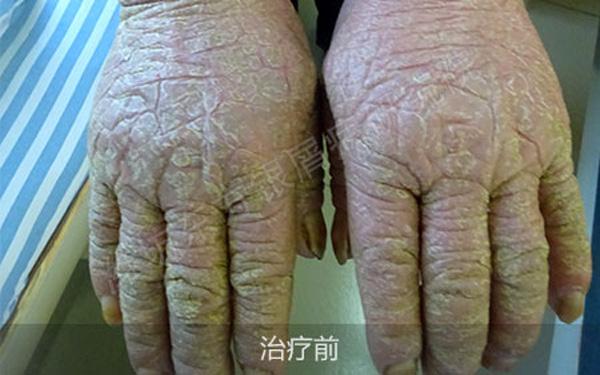 关节型牛皮癣用什么药,牛皮癣的种类和特征