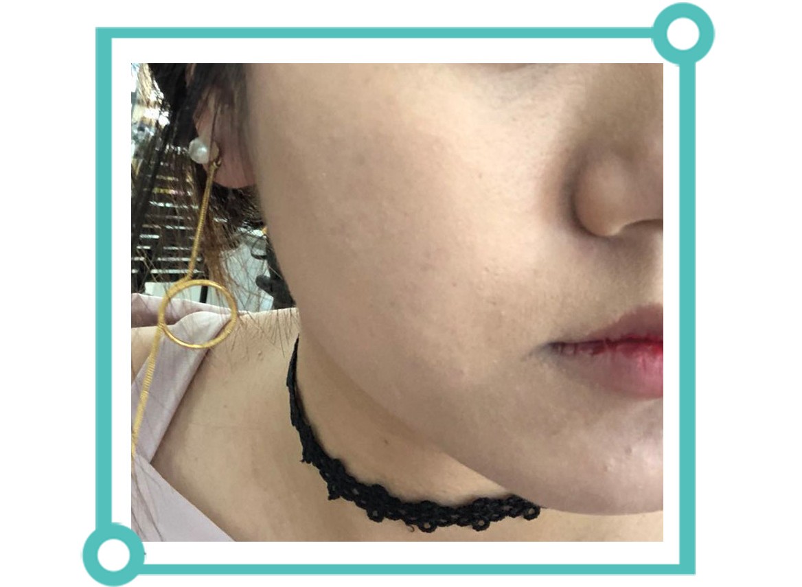 怎样消除痘印食疗,青春期痘印怎么消除小妙招