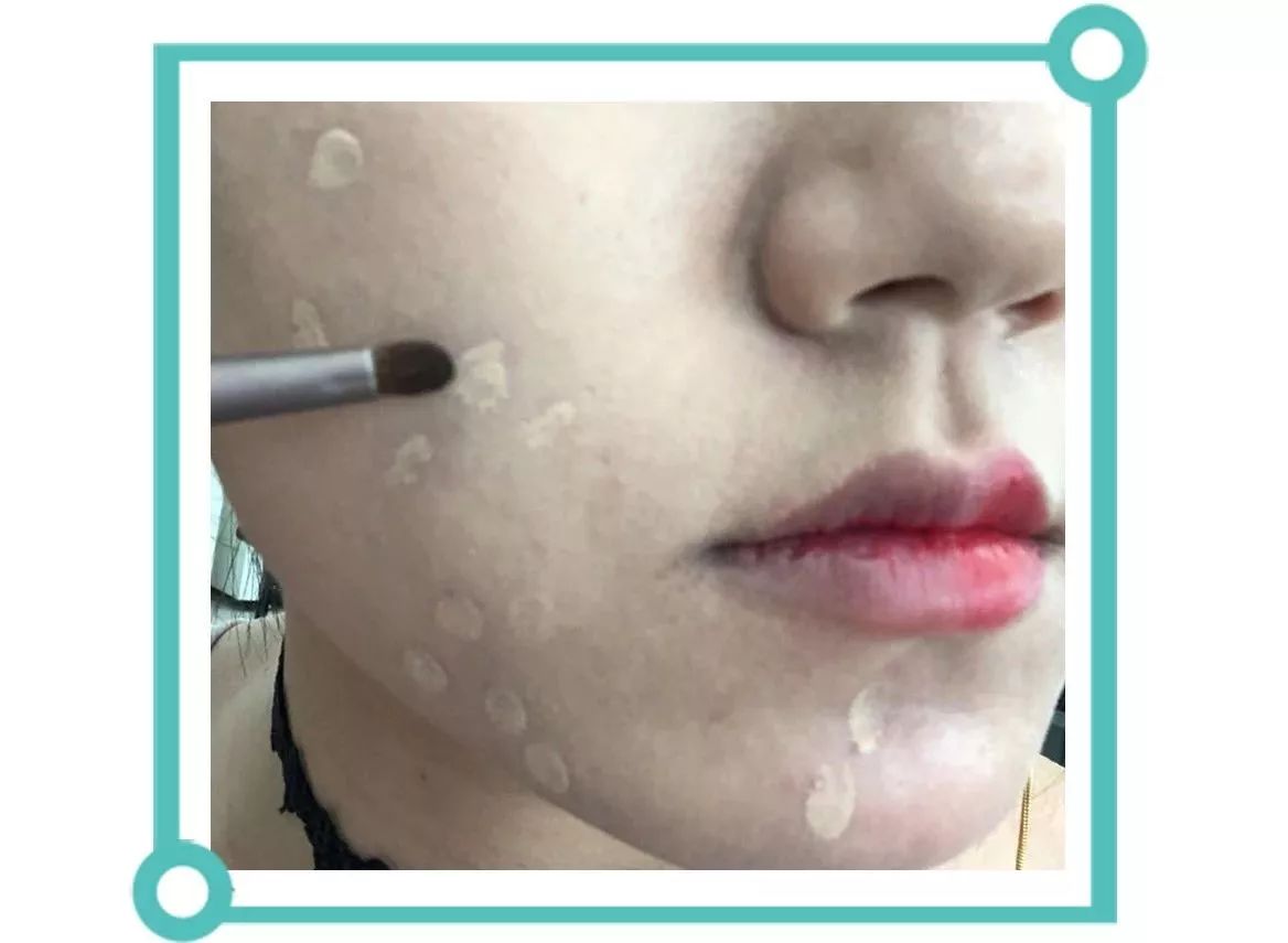 青少年痘印怎么消除小妙招,如何消除痘印祛痘