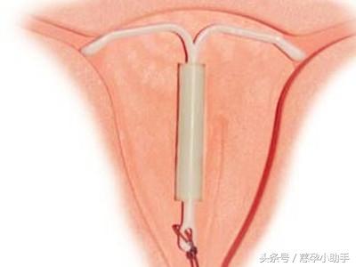 备孕生二胎，宫腔内的节育环该怎么处置？取环真相提前知道！