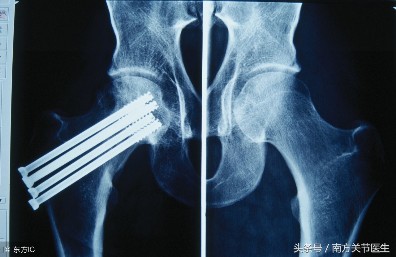 治疗股骨头骨折的特效药,股骨颈骨折股骨头坏死早期治疗