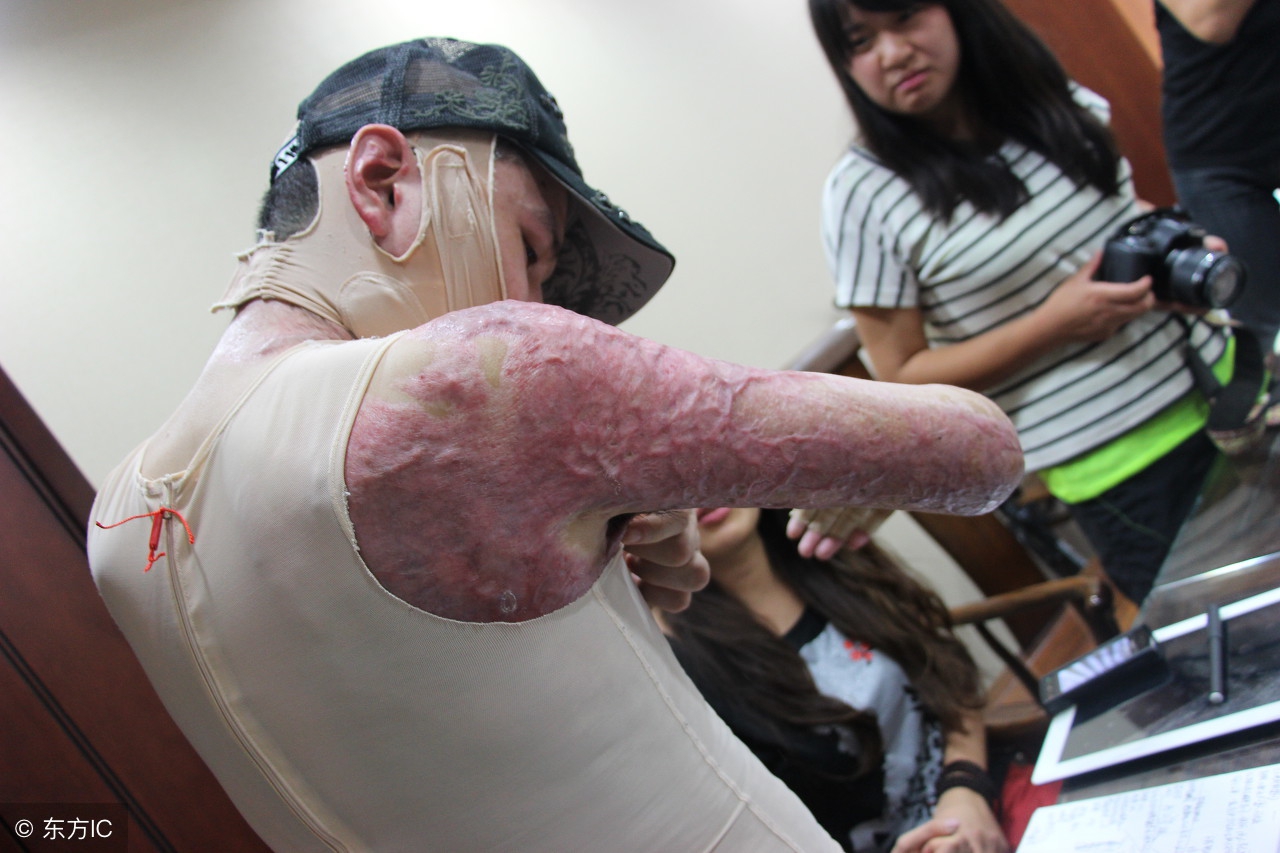 严重烧伤急救措施,严重烧伤病人应采取什么措施