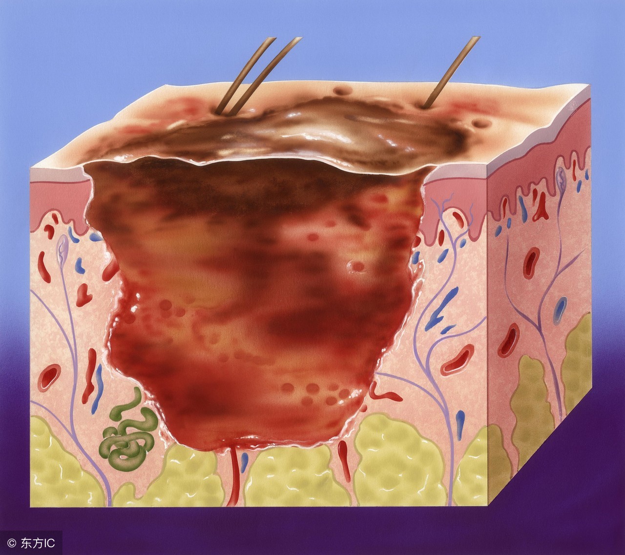 严重烧伤病人的急救措施包括,大面积烧伤怎么紧急处理