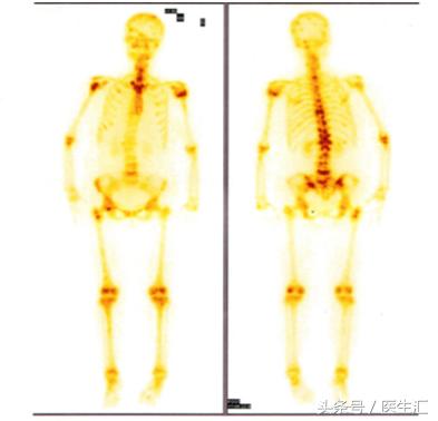 晚期乳腺癌病例,浸润性小叶乳腺癌3级