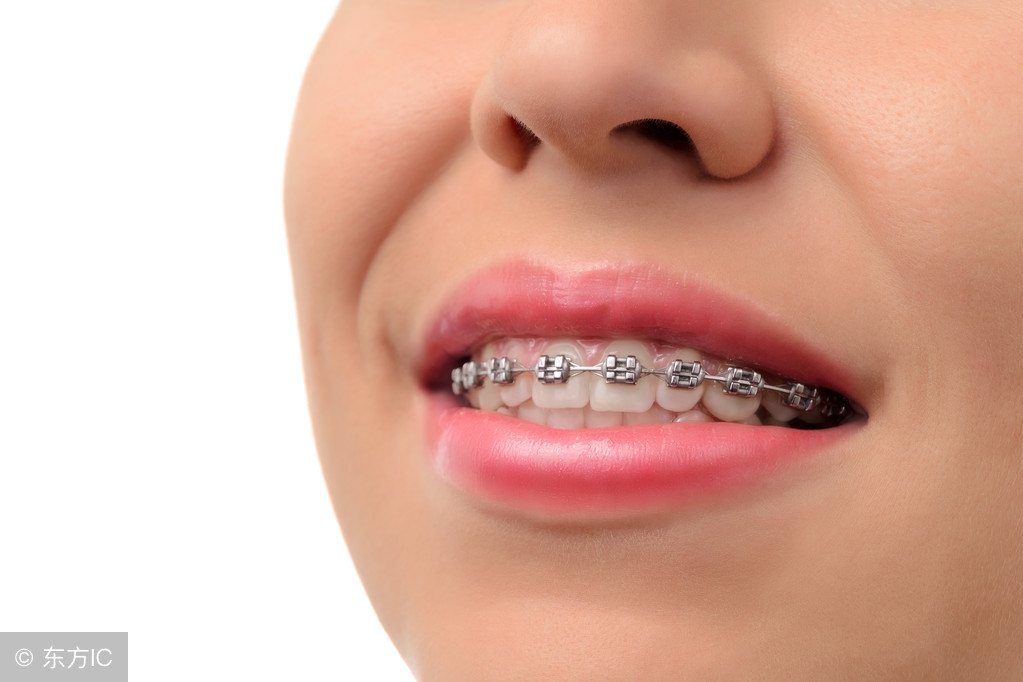 牙齿正畸堪比整容,牙齿矫正堪比整形