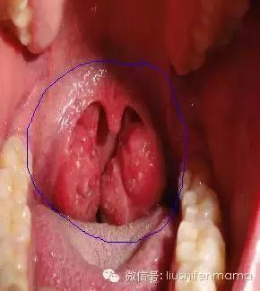 扁桃体炎引起的高烧不退咽喉脓肿，只能靠吃药吗？！
