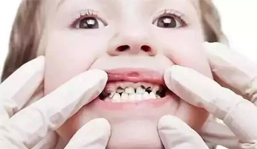 儿童蛀牙严重的牙齿都烂掉了,2岁多宝宝牙齿开始烂了