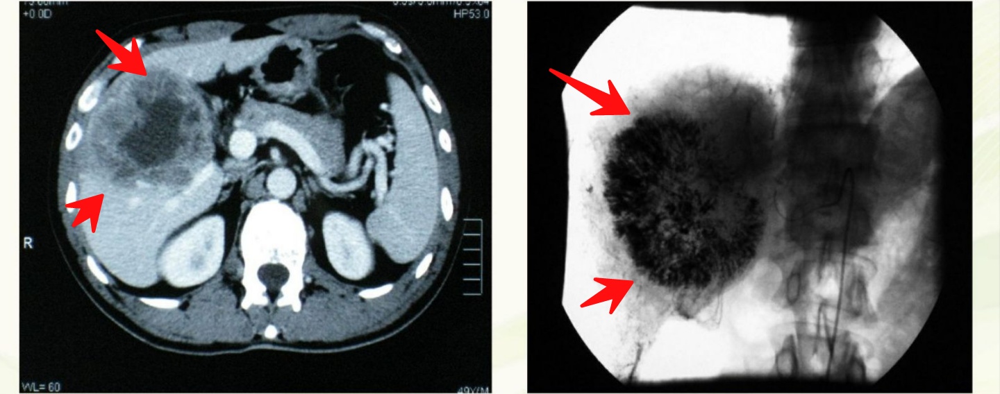 肝癌晚期肝硬化腹水能活多少时间,肝癌晚期用钇90疗法能活多少年