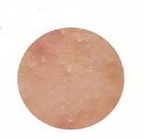 「去闭口大作战」令人困扰的闭口和痘痘！闭口到底是什么？