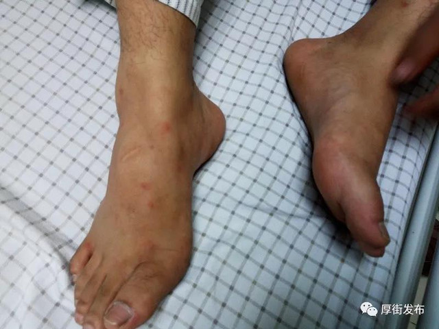 被蚂蚁咬保命,男子不慎被蚂蚁咬