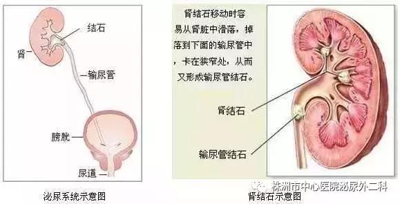 突破！无管化微创经皮肾镜取石术治疗儿童泌尿系结石