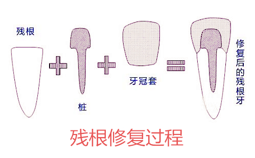 牙齿龋坏就剩牙根怎么处理,牙齿龋坏放任不管能坚持多久