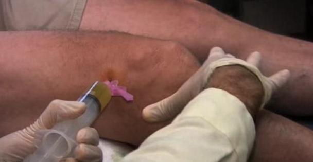 膝关节积液膝盖肿,膝关节置换后膝盖积液怎么治疗