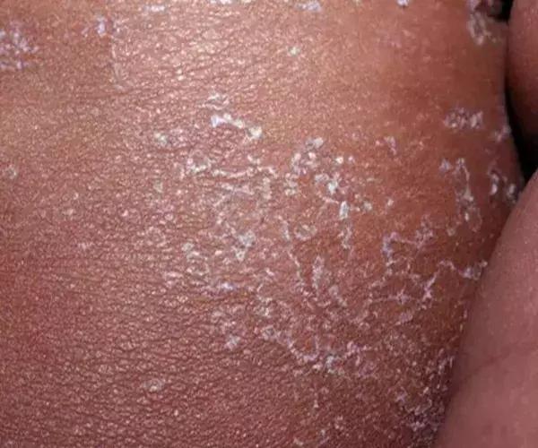 夏季猩红热高发家有娃娃要当心,为什么猩红热高发于儿童