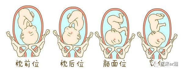 胎位不正是小孩畸形吗,胎位不正怎么顺产