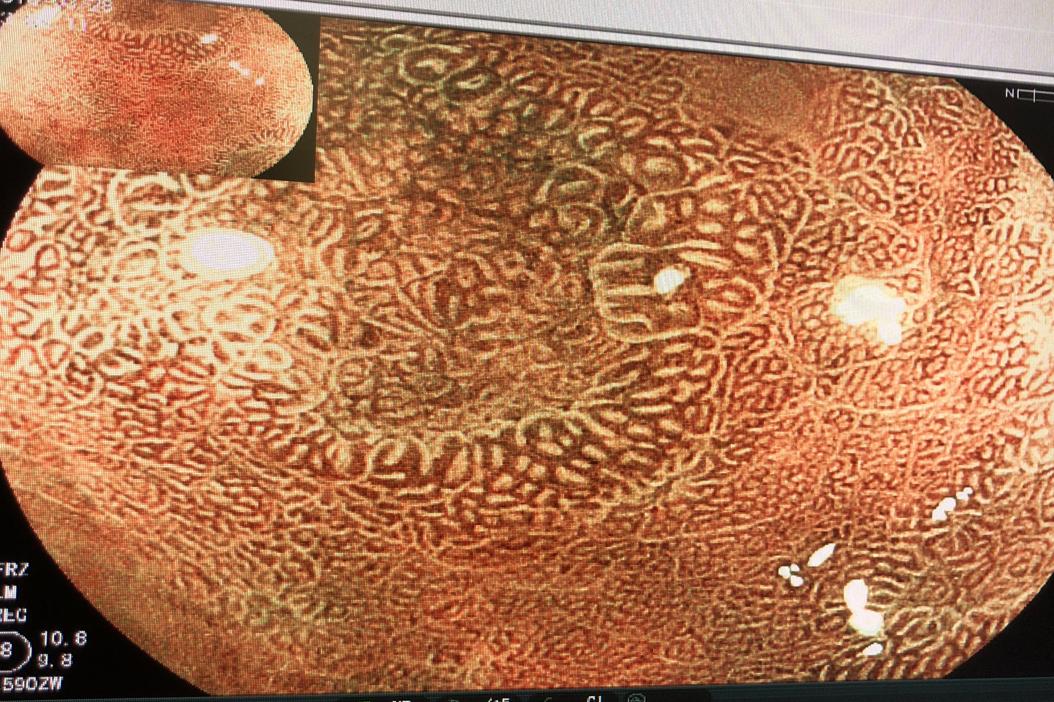 什么是慢性胃炎伴肠上皮化生？