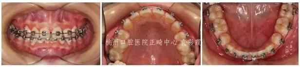 原来，上牙盖住下牙太多，也对牙齿有伤害！该怎么矫正？