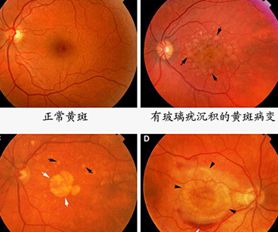 黄斑病变引起眩光怎么治疗,老人眼黄斑病变的治疗方法