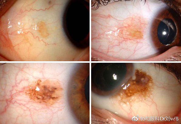 非典型性spitz痣是黑色素瘤吗,很大的一颗痣会变黑色素瘤吗