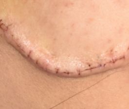 整形术后不冰敷,整形疤痕多久可以恢复