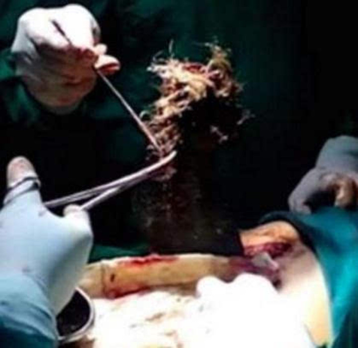 温州7岁女孩患“异食癖”偷吃头发6年！医生开腹取出成团头发