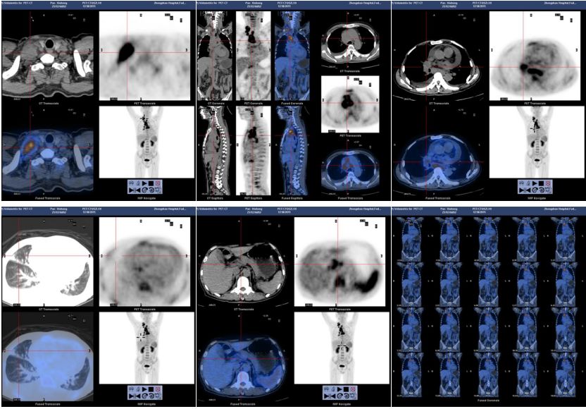 抗核治疗后反而病情加重？这个病例太经典了！