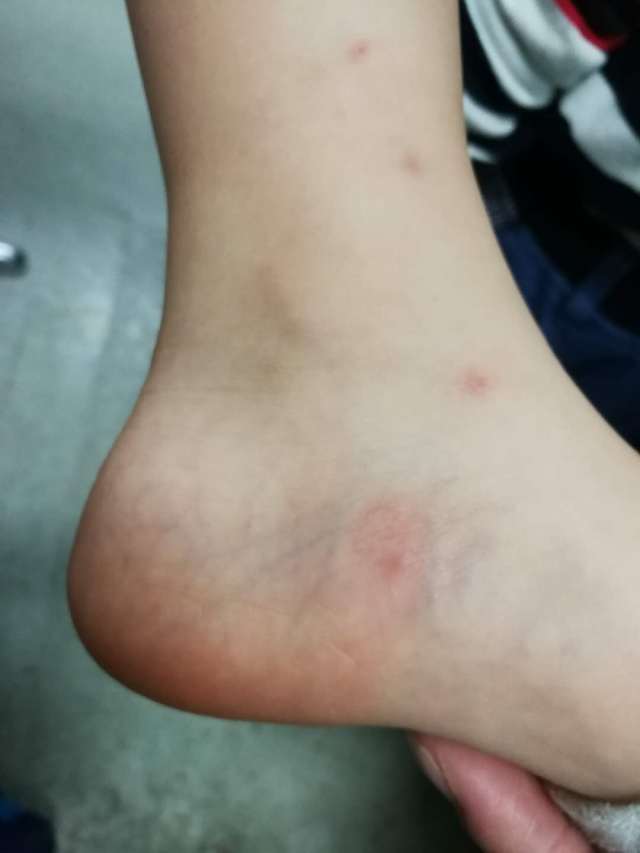 蚊子咬了很大的疙瘩是荨麻疹吗,被蚊子咬后就成荨麻疹