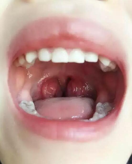 宝宝做完腺样体手术吃什么好,腺样体手术做完怎么护理孩子
