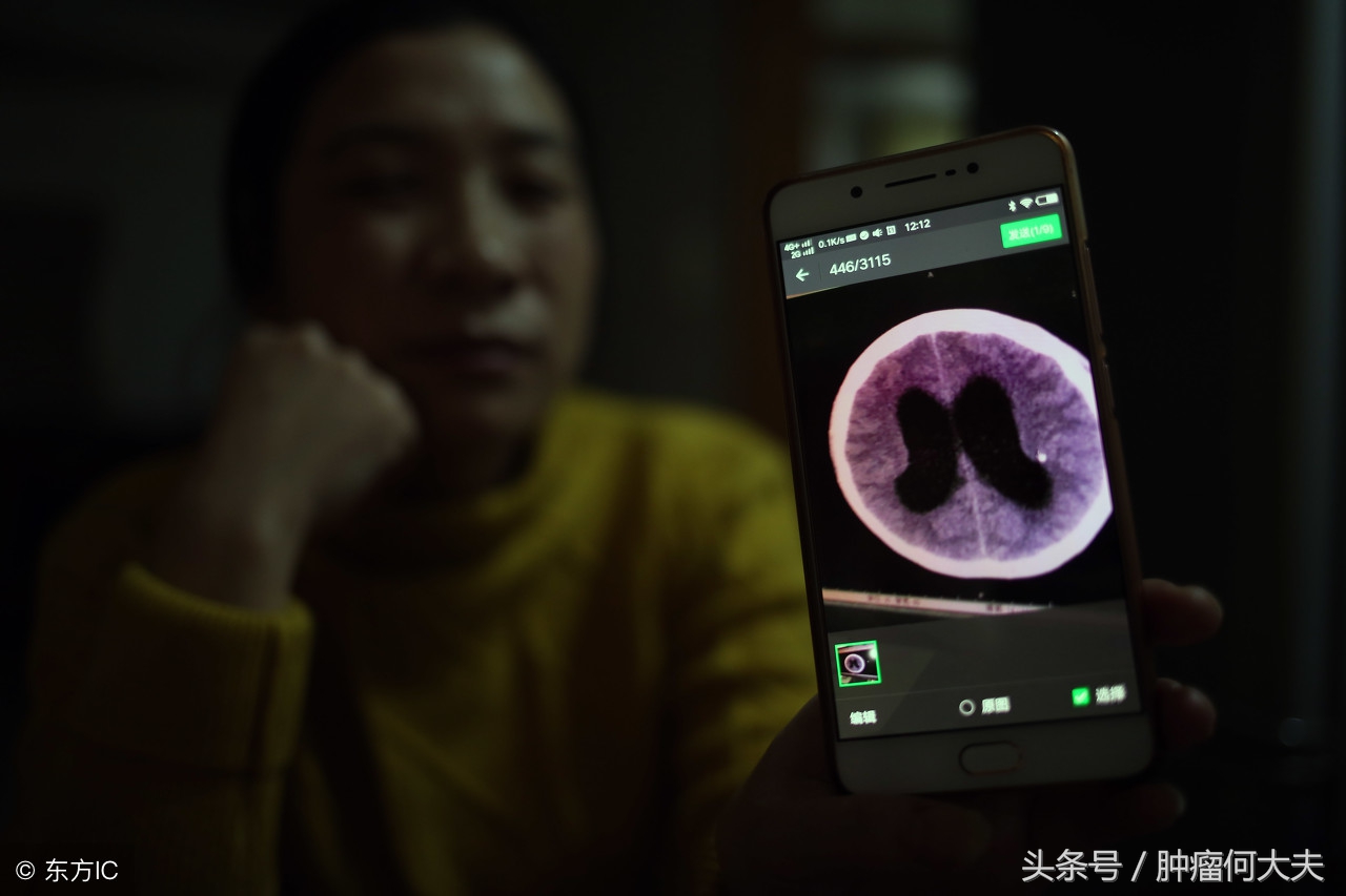 脑膜瘤是良性？恶性？症状如何？如何治疗？