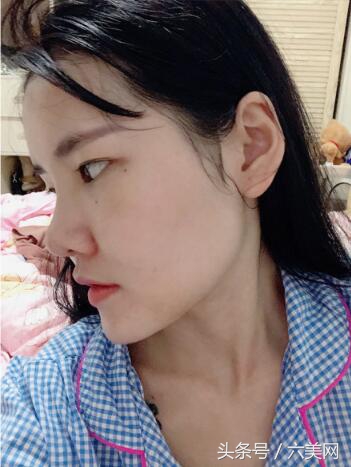隆鼻后如何克服焦虑,隆鼻后前三天状态