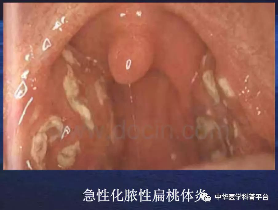 急性扁桃体炎吃阿奇霉素可以吗,急性扁桃体炎吃什么消炎药