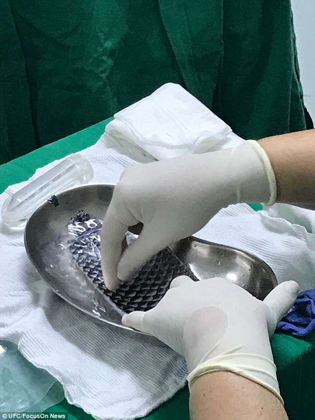 巴西女子天生没有阴道,成功手术安装鱼皮阴道,系全球首例