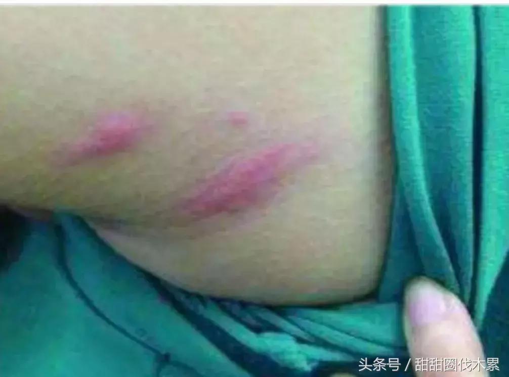 孩子螨虫过敏家里怎么除螨,怎样才能让螨虫彻底消除