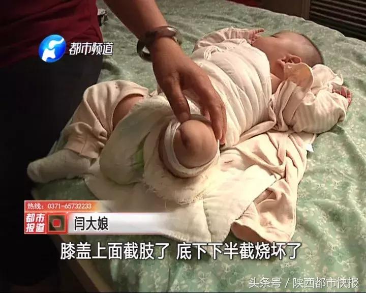 因父亲一时疏忽五岁小女孩截肢,宝宝刚出生就被截肢两只腿都没了