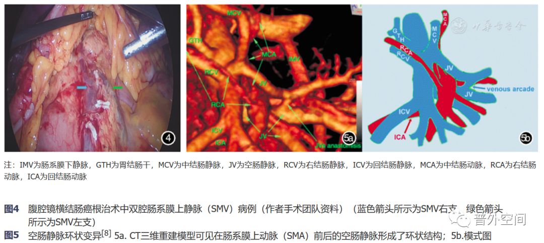 腹腔镜完整结肠系膜切除术相关血管变异与术中出血的应对措施(上)