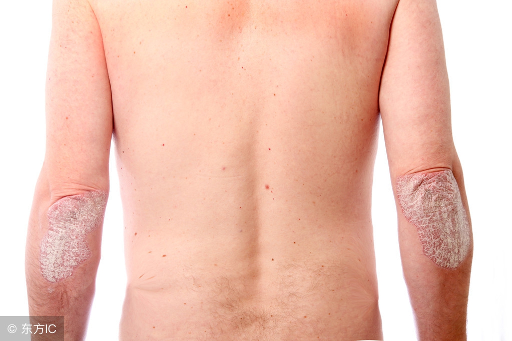 头癣和头部牛皮癣,头癣和癣疣的区别