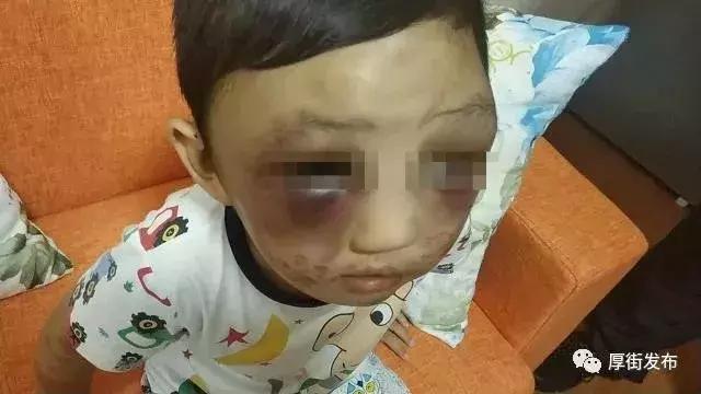 4岁男孩被打满身伤痕,小孩被父母暴打脸打肿