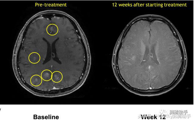 第四代抗癌新药,抗癌新药拉罗替尼
