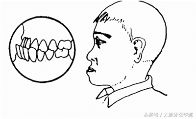 儿童地包天要怎么矫正,儿童地包天要怎么矫正视频
