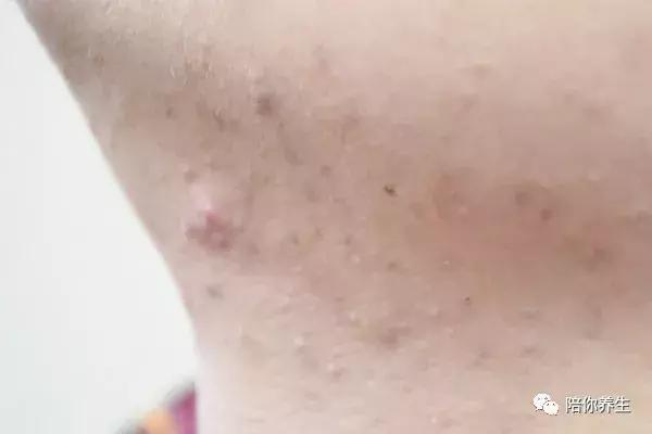 湿气重内火旺盛喝什么茶,内火大湿气重喝哪种茶