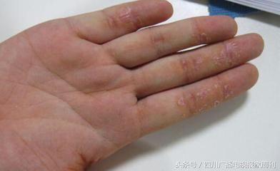 手上脱皮是缺维生素b几,手掌脱皮是缺乏哪种维生素