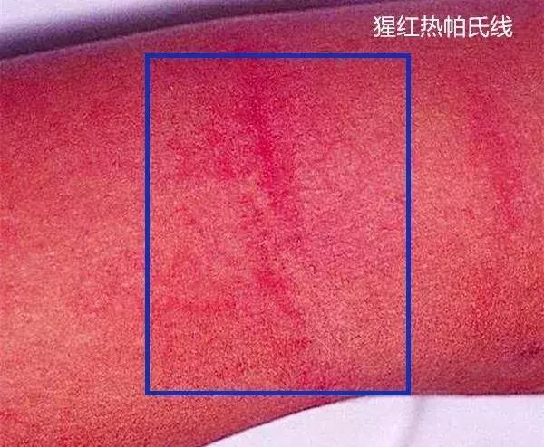 小儿手足口症状和治疗方法,小儿手足口最早期要怎么治疗