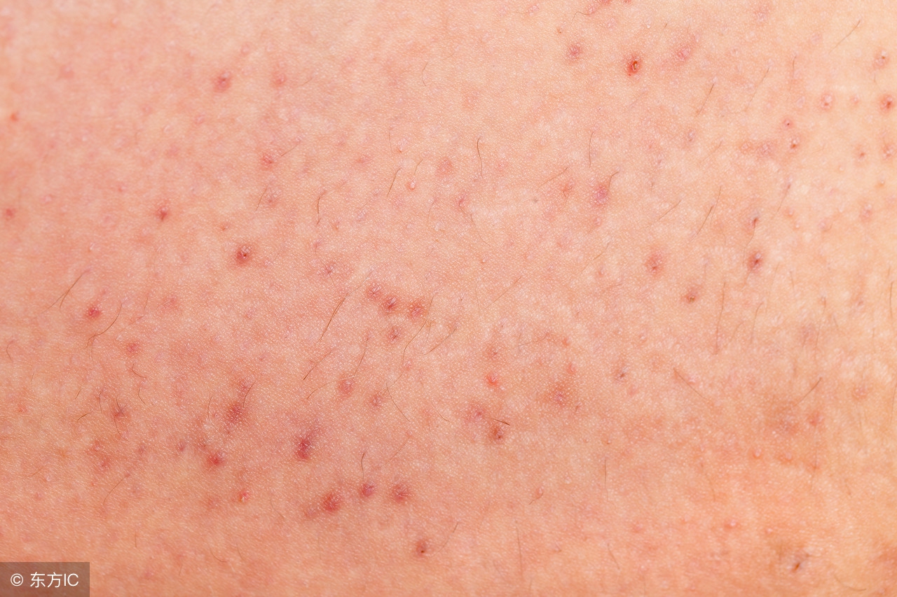 毛囊炎导致的脱发可以治得好吗,秃发性毛囊炎脱发还能长出来吗