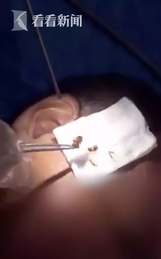 女子发烧十七天,女子发烧21天